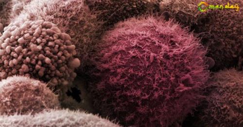 Pancreatic cancer has a poor prognosis