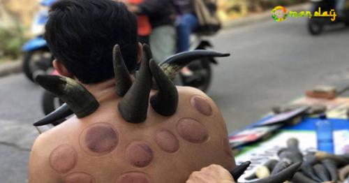 Indonesian Street Therapists Use Heated Water Buffalo Horns for Cupping Treatment