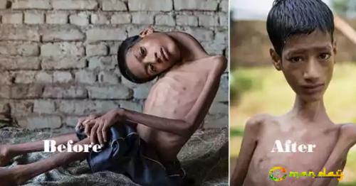 This Boy Was Born With Rare Condition, Underwent a Life Changing Surgery