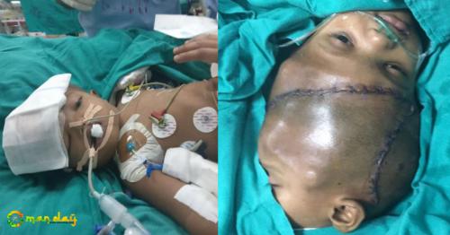 Indian surgeons separate twins joined at the head