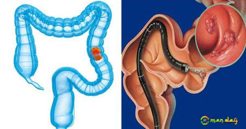 Colon Cancer