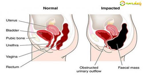 Say Goodbye To Belly Bloat Forever! These 4 Simple Tips Will Help You To Flatten Your Stomach Starting Today!