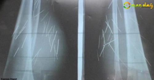 70 needles, pins found in woman&rsquo;s legs in India