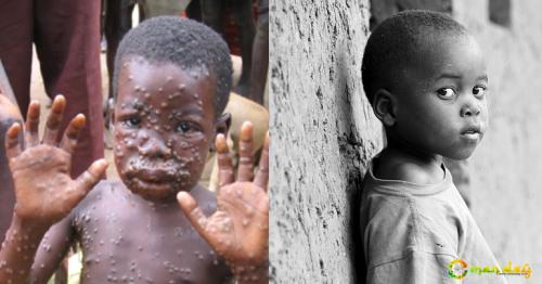 Disease Control Experts Work on Eradicating Deadly ‘Monkeypox’ in Africa to Prevent Outbreak