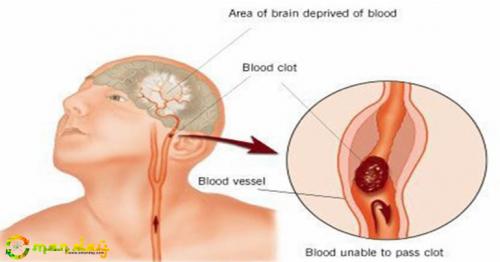 These Are The 7 Signs Of Stroke You Should Know Before It&rsquo;s Too Late