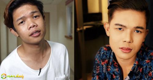 Xander Ford’s Face Began To Return On Its Original Form Few Months After Surgery?