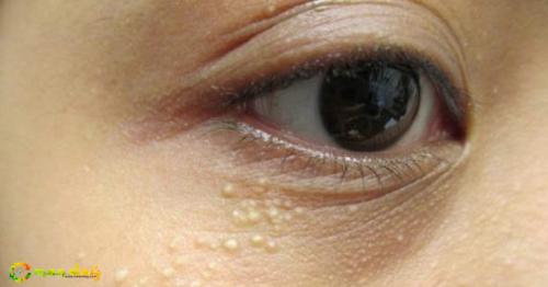 How to Remove Syringomas Permanently at Home