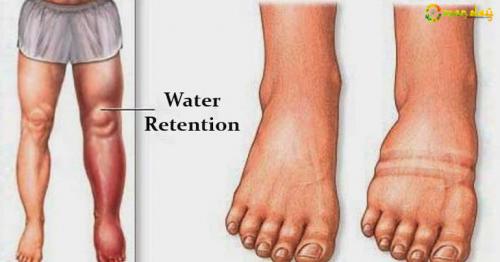 6 Causes of Water Weight Gain and Effective Ways to Reverse Water Retention