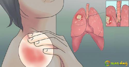 20 Early Warning Signs Of Lung Cancer That Women Should Never Ignore