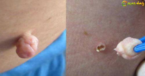 I Eliminated The Warts On My Skin Without Leaving A Trace And I&rsquo;am Very Happy For That!