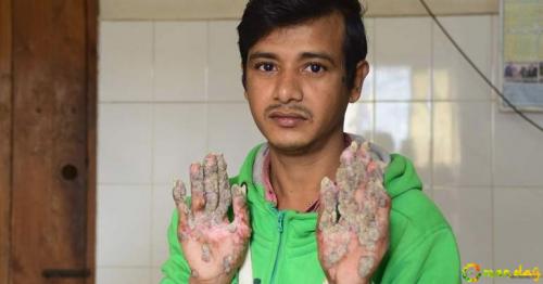 Bangladesh &rsquo;tree man&rsquo; trapped in hospital for two years