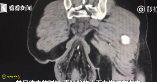 
Man&rsquo;s Rectum Fell Out Of Body After Sitting On The Toilet For 30 Minutes