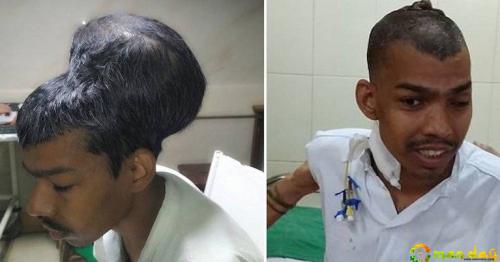 Mumbai Doctors Remove World&rsquo;s Largest Brain Tumour Weighing 1.8Kg