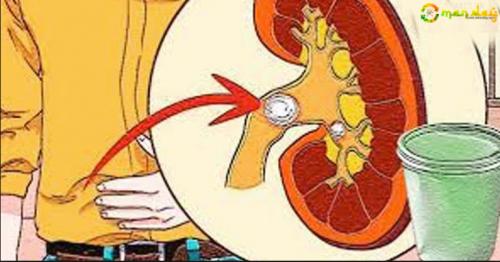 I Had 2 Stones In My Right Kidney, And Only With This Water I Take Them Out By The Roots And Leave It As A New Filter