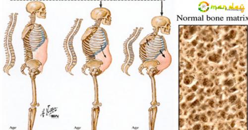 The Drink That Can Destroy Your Bones!