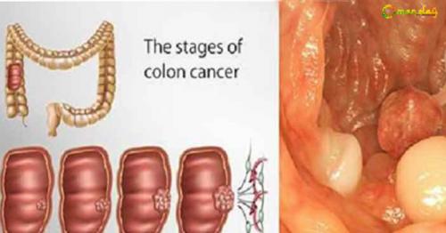 50% of All Colon Cancer Cases Can Be Avoided If We Stay Away from These 9 Things