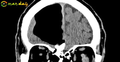  Doctors Find Air Pocket Where Part Of Man&rsquo;s Brain Should Be