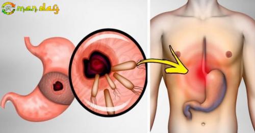 Here Is How To Kill The Bacteria That Causes Heartburn And Bloating