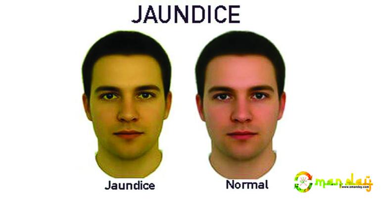 Jaundice