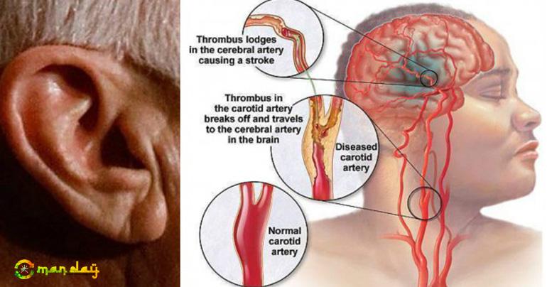 4 Silent Signs You May Have Clogged Arteries and How to Unclog Them Naturally