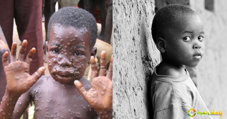 Disease Control Experts Work on Eradicating Deadly ‘Monkeypox’ in Africa to Prevent Outbreak