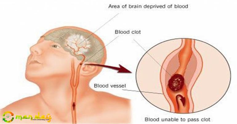 These Are The 7 Signs Of Stroke You Should Know Before It&rsquo;s Too Late