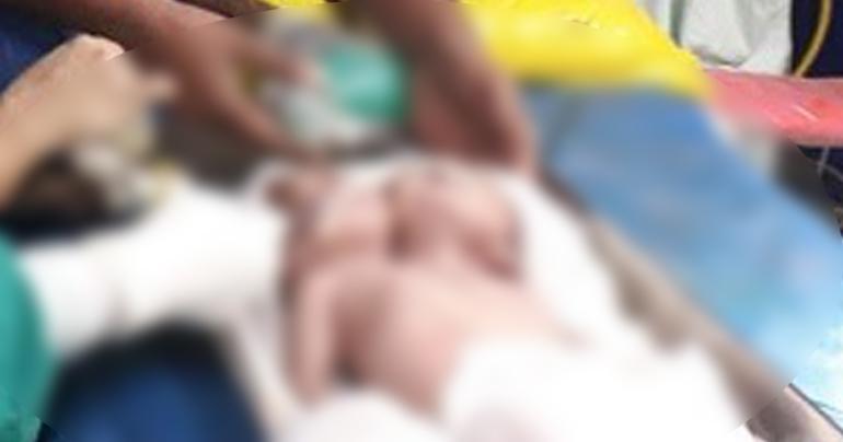 Conjoined twins with single heart and liver pass away