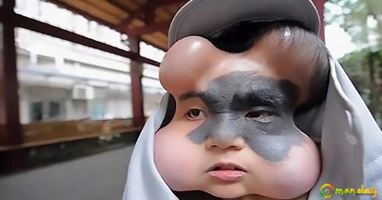 Woman with Cancerous Facial Mole has Four Balloons Implanted in Her Face to Stretch the Skin