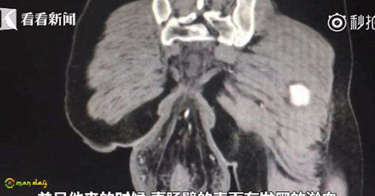 
Man’s Rectum Fell Out Of Body After Sitting On The Toilet For 30 Minutes