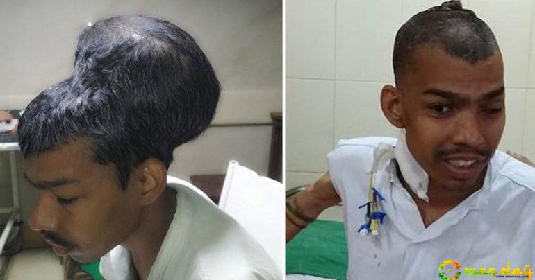 Mumbai Doctors Remove World&rsquo;s Largest Brain Tumour Weighing 1.8Kg