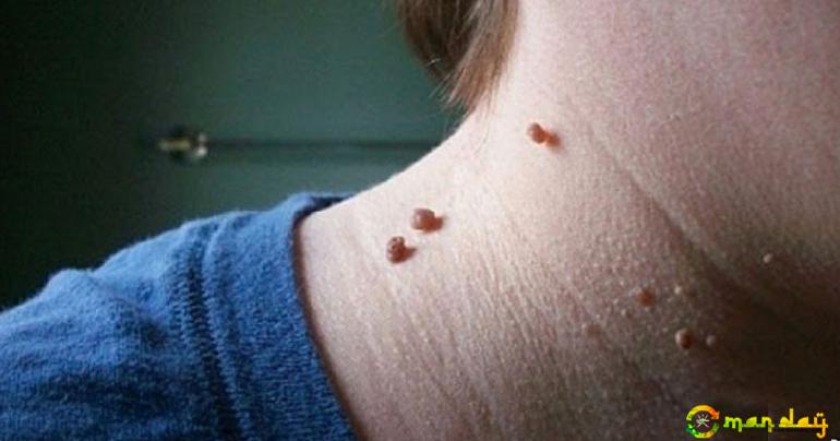 Get rid of skin problem or Fibromas without spending a bomb!