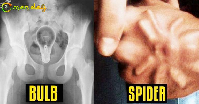 10 Weirdest Things Found Inside Human Body!