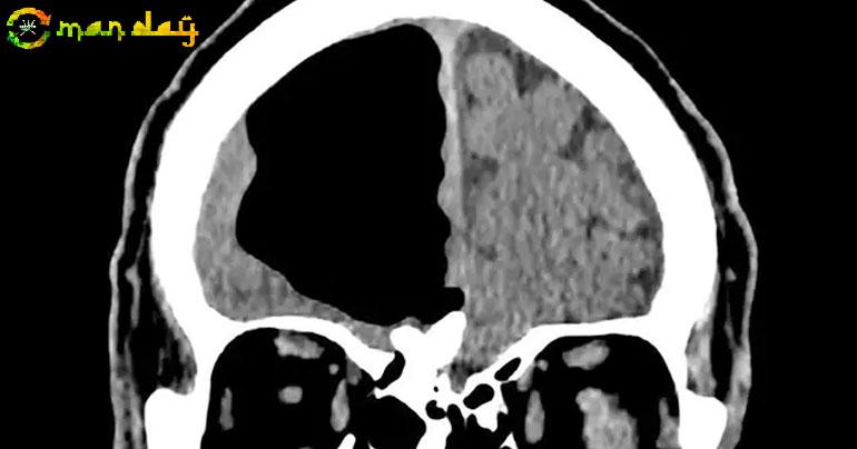  Doctors Find Air Pocket Where Part Of Man’s Brain Should Be