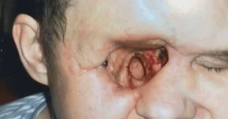 Eye cancer misdiagnosed as migraine left giant hole in man’s face
