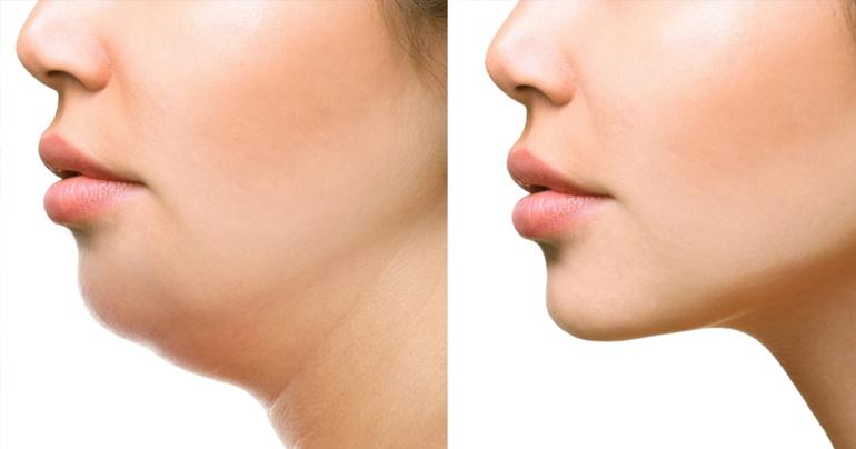 Exercises to Get Rid of Double Chin